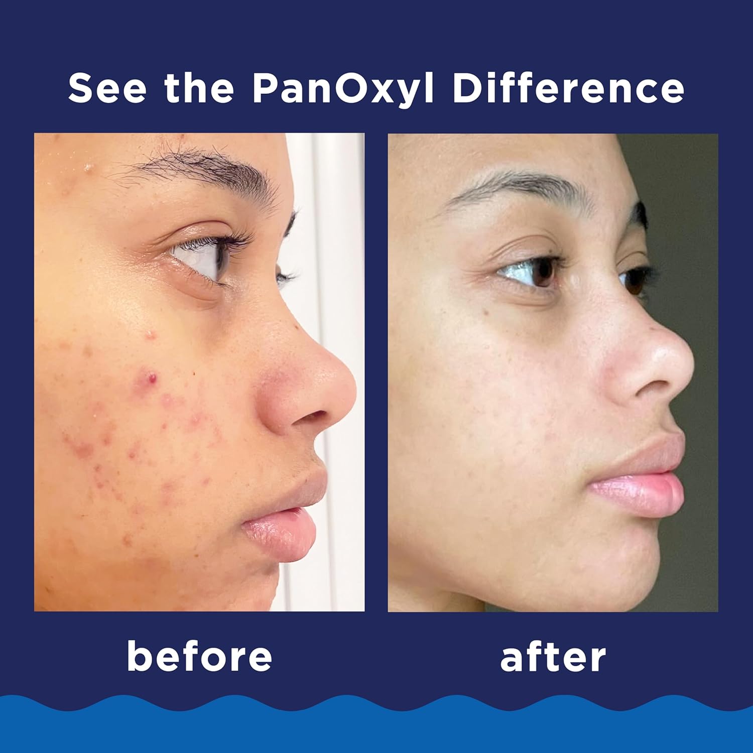 714jGCd93RL._SL1500_ PanOxyl Acne Foaming Wash Benzoyl Peroxide 10% Maximum Strength Antimicrobial, 5.5 Oz